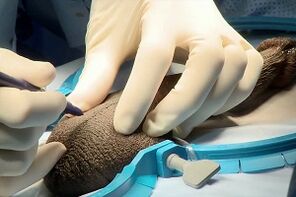 Incizie midge pentru mărirea penisului chirurgical