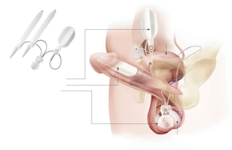 implanturi de gel în penis